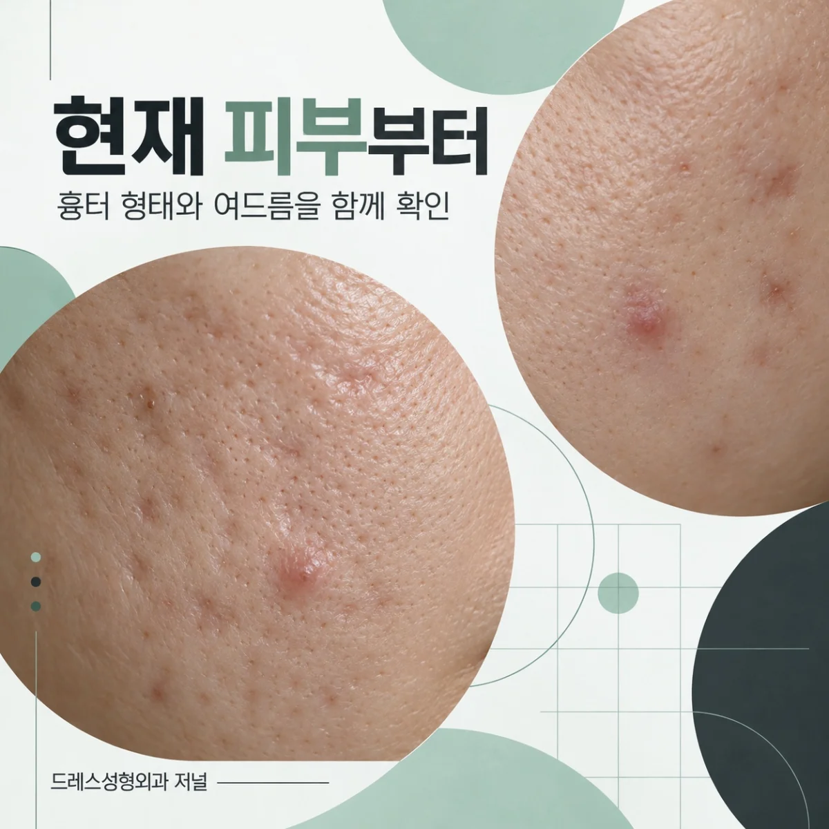 현재 피부부터 — 흉터 형태와 여드름을 함께 확인