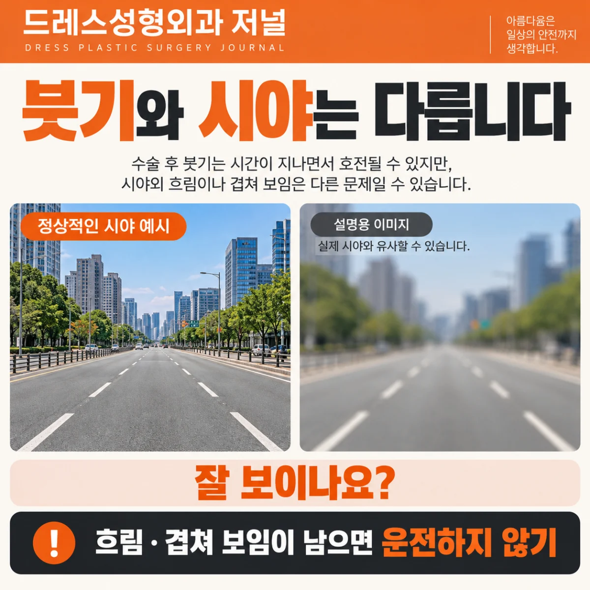 붓기와 시야 선명도는 다르다는 설명용 이미지