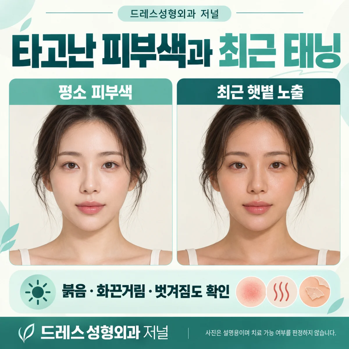 평소 피부색과 최근 태닝 및 자극을 구분하는 설명 카드