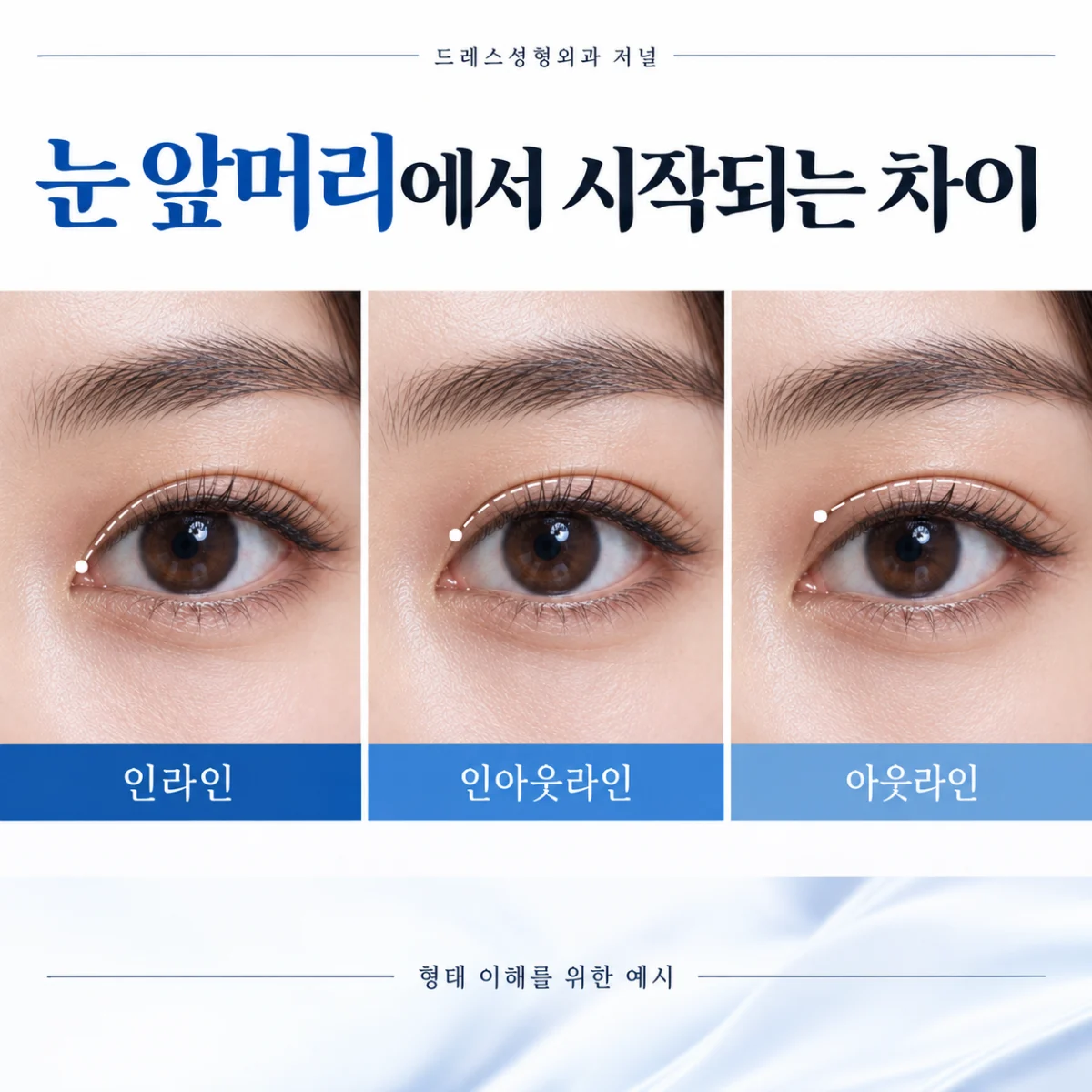 눈 앞머리에서 시작되는 차이 — 이해를 위한 AI 생성 설명 이미지, 실제 환자 사례나 시술 결과가 아닙니다.