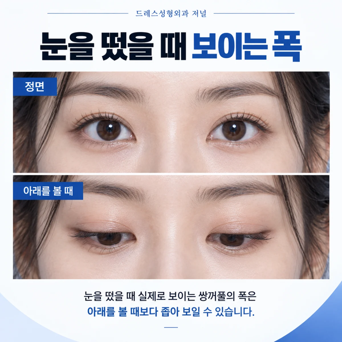 눈을 떴을 때 보이는 폭 — 이해를 위한 AI 생성 설명 이미지, 실제 환자 사례나 시술 결과가 아닙니다.