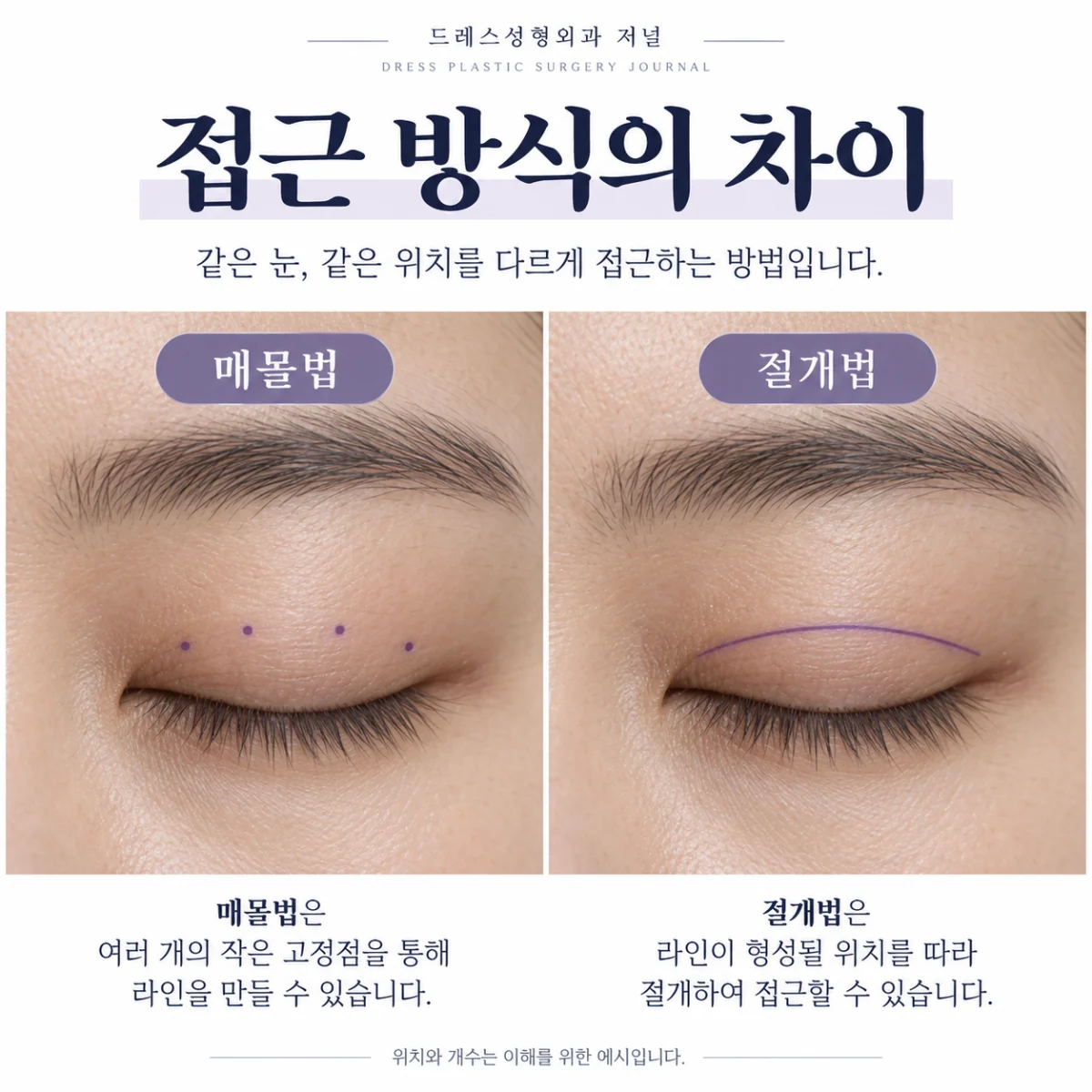 같은 눈의 매몰 접근점과 절개선 위치를 단순화한 비교