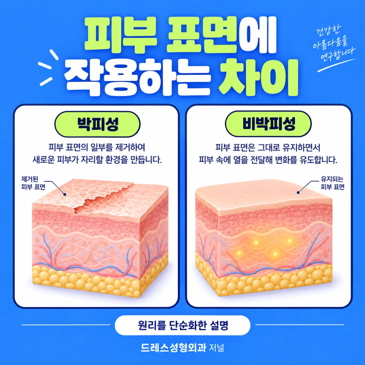 피부 표면에 대한 두 방식의 단순화한 설명
