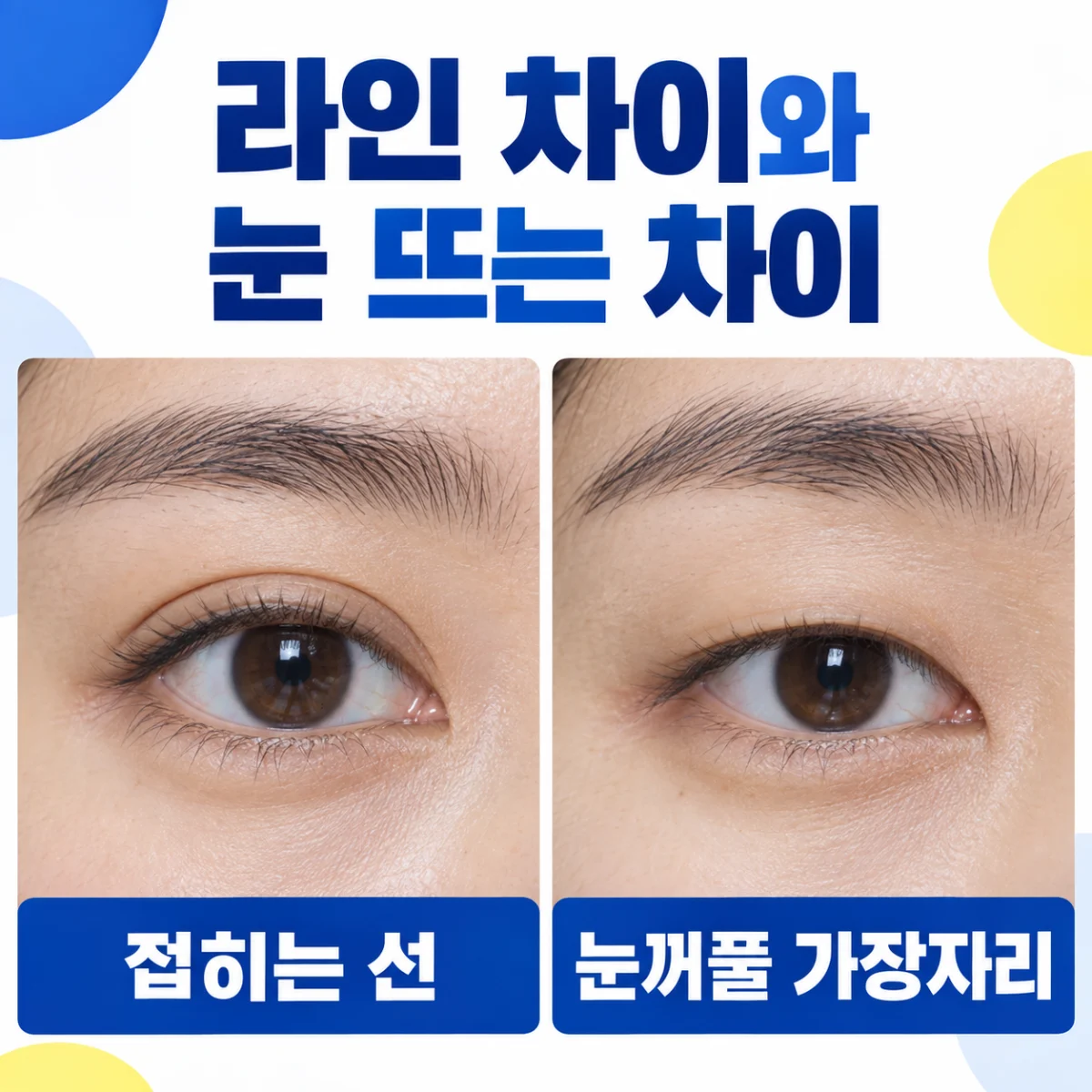 쌍꺼풀 접힘과 눈꺼풀 가장자리의 차이를 설명하는 눈 사진