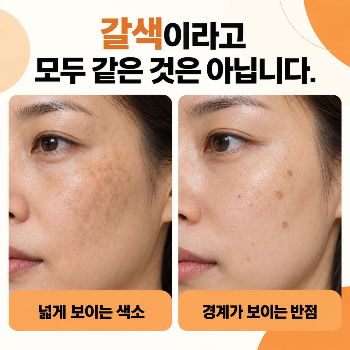 넓게 보이는 색소와 경계가 보이는 반점의 형태 예시