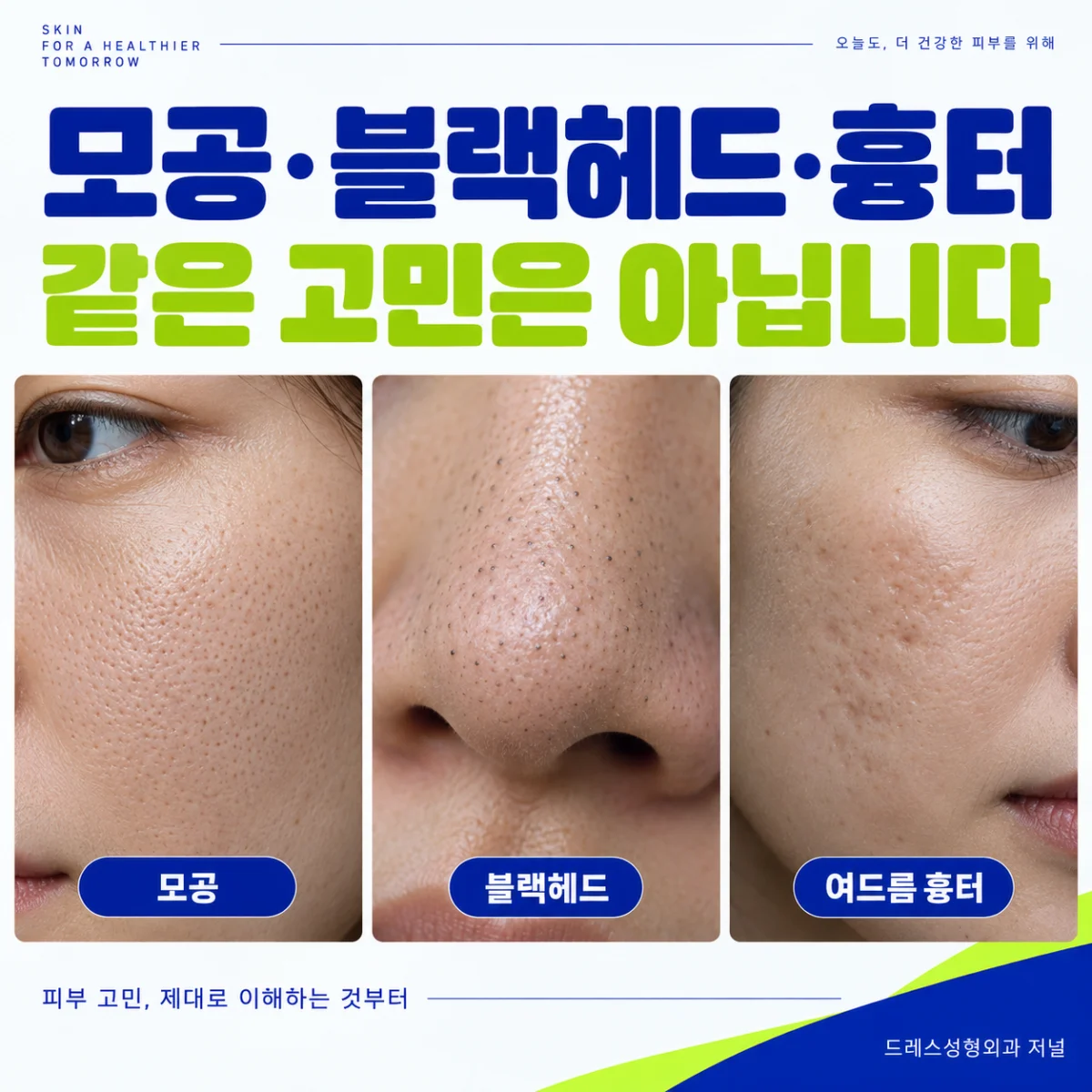 모공과 블랙헤드 및 여드름 흉터를 구분하는 확대 사진