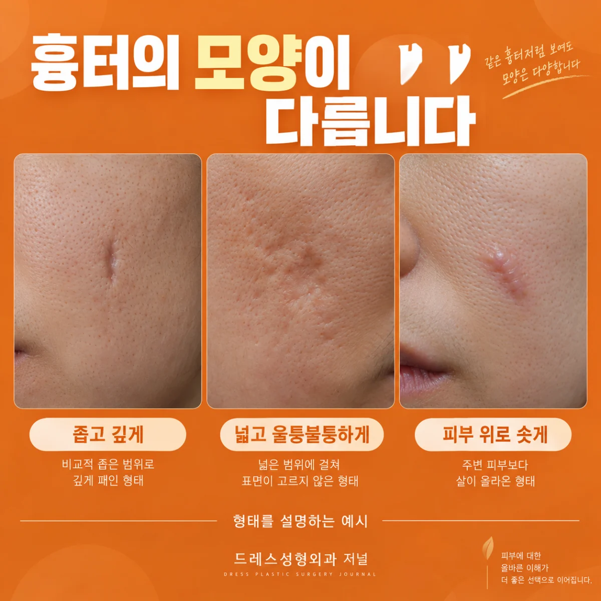 폭과 모양이 다른 패인 흉터를 설명하는 피부 확대 사진